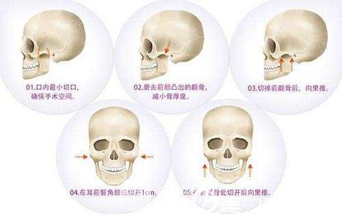 磨骨手術與截骨手術的區(qū)別竟然這么大